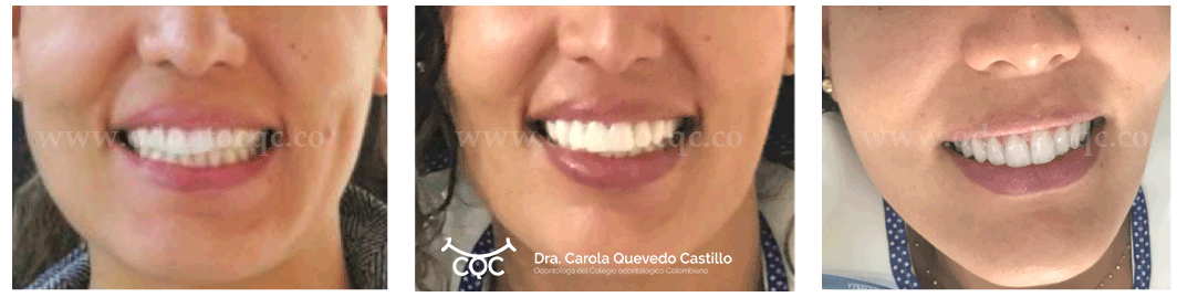 Consultorio odontológico CQC servicio de diseño de sonrisa ODONTO CQC