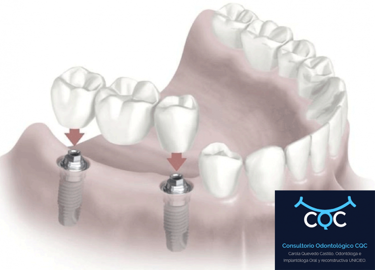 ¿Cuánto cuesta un implante dental? CQC